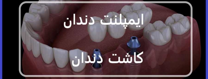 ایمپلنت دندان و کاشت دندان چیست