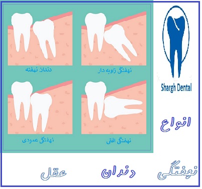 انواع نهفتگی دندان عقل